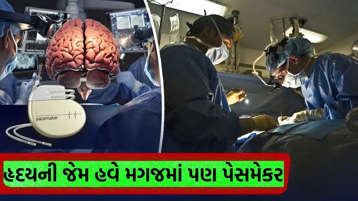 દિલ્હીની RML હોસ્પિટલમાં પહેલીવાર ડીપ બ્રેઇન સ્ટીમ્યુલેશન સર્જરી, નેપાળી મહિલાના મગજમાં પેસમેકર