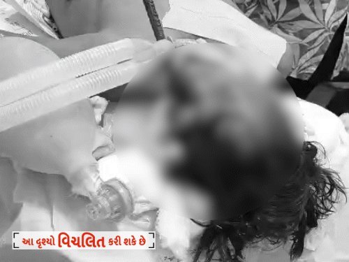 સુરત: મંદિર બાંધકામ સ્થળે યુવકના માથામાંથી 3.5 ફૂટનો સળિયો પસાર, 10 ડોક્ટરોની ટીમે 4 કલાકની સર્જરી કરી બચાવ્યો
