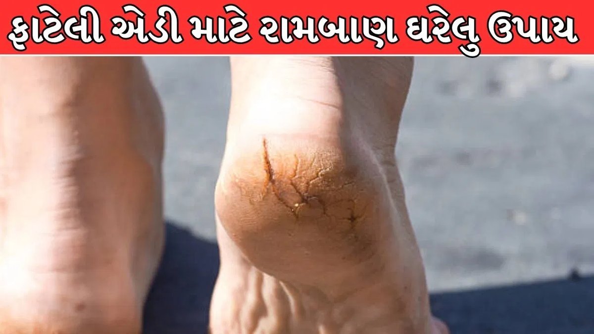 ફાટેલી એડી માટે 5 સરળ ઘરેલુ ઉપાય: જાણો શું કરવું