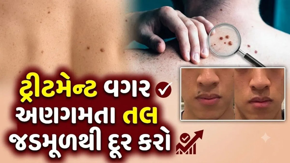 ચહેરાના તલથી છુટકારો: ખર્ચાળ ટ્રીટમેન્ટ છોડીને અજમાવો આ ઘરગથ્થુ ઉપાયો