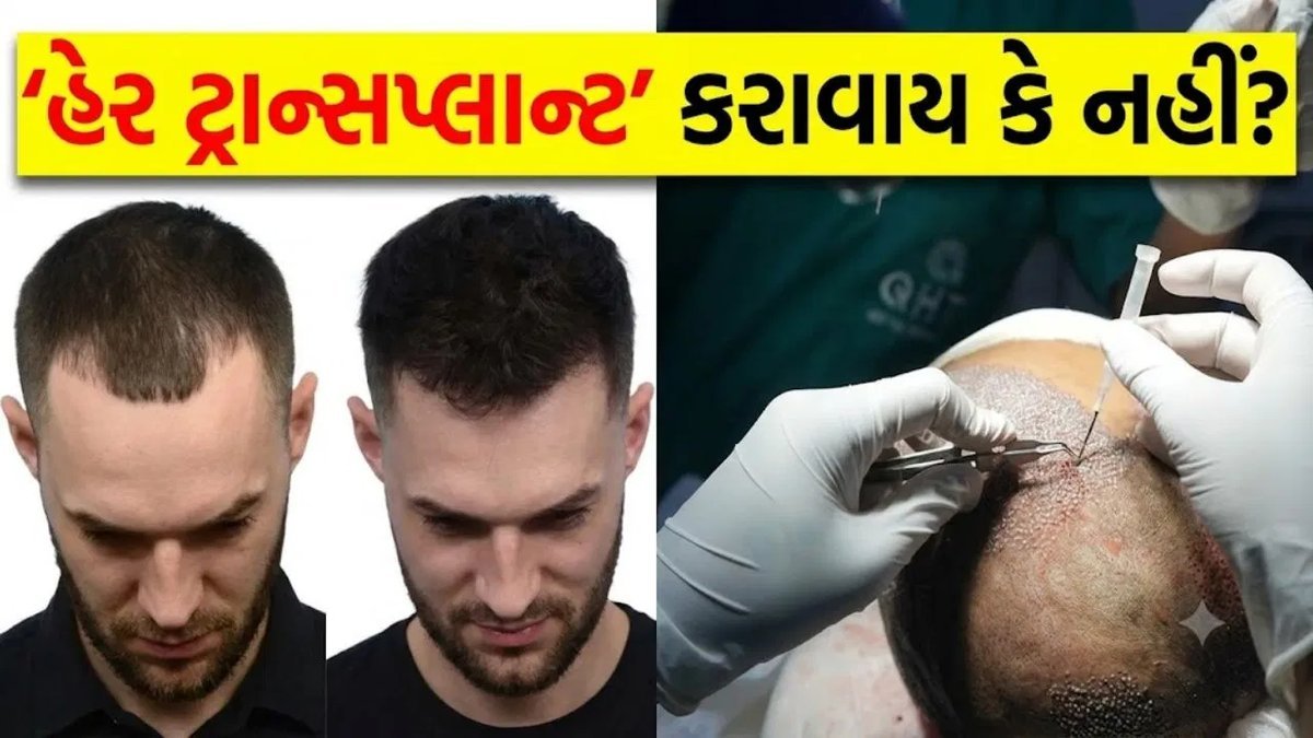 હેર ટ્રાન્સપ્લાન્ટ કરાવતા પહેલાં આ 5 વાત ધ્યાનમાં રાખો, નહીં તો પસ્તાવો થશે